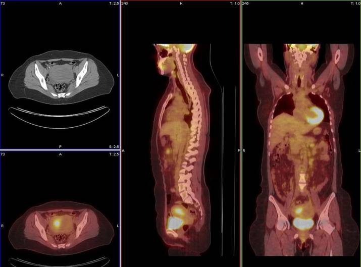 PET CT
