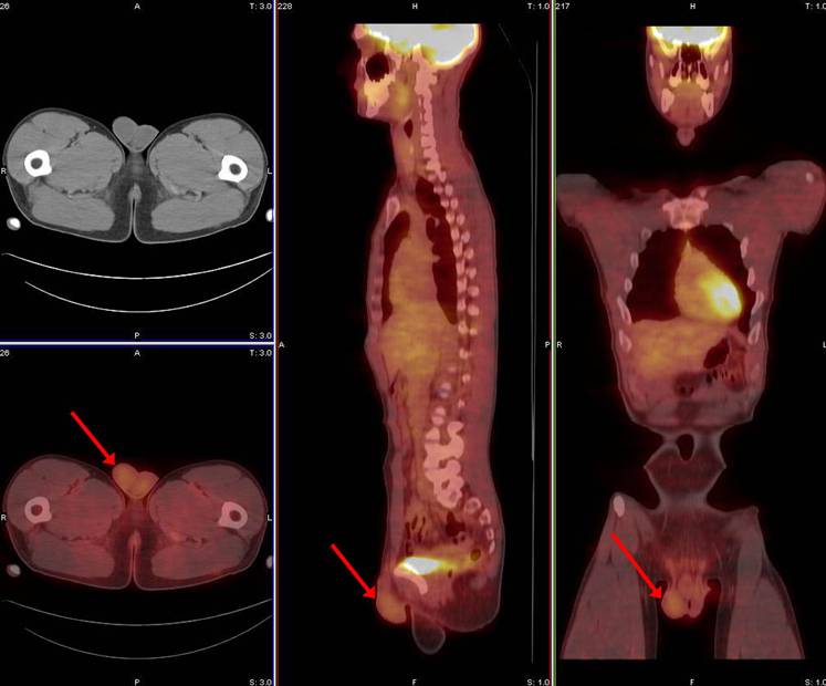 pet-ct