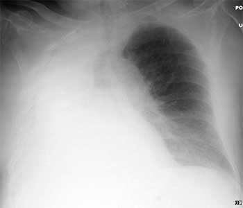 Patient with right lung atelectasis