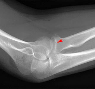 occult radial head fracture
