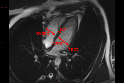 Myocardial Strain Evaluation with Cardiovascular MRI: Physics