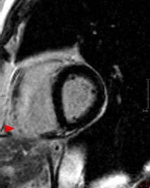 Cardiac MRI