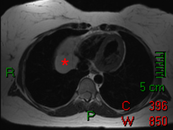 Cardiac MRI