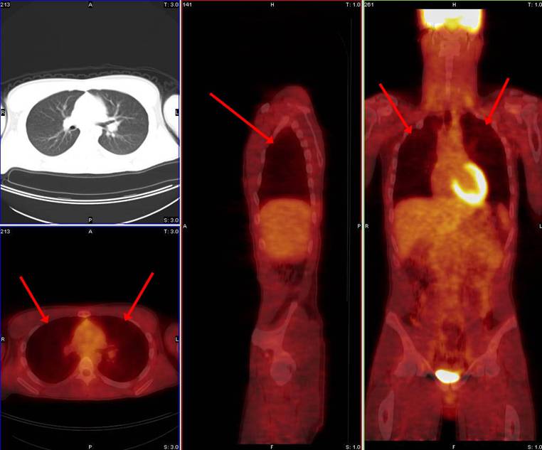 What Happens During A Pet Scan Of The Lungs