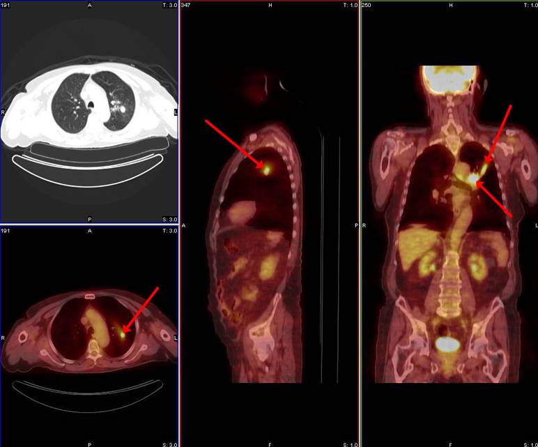 pet-ct