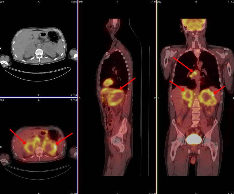 pet-ct