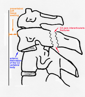 Odontoid and hangman fracture