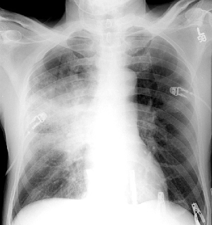 lobar pneumonia chest xray