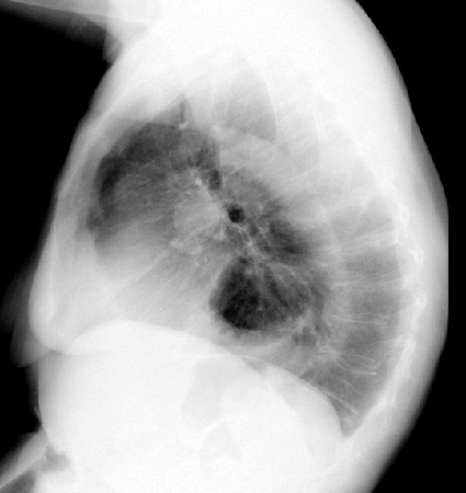 paraesophageal hernia x ray