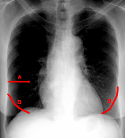 Image: Chest X-Ray of a Patient with Fluid in Minor and Major Fissures -  Merck Manuals Professional Edition