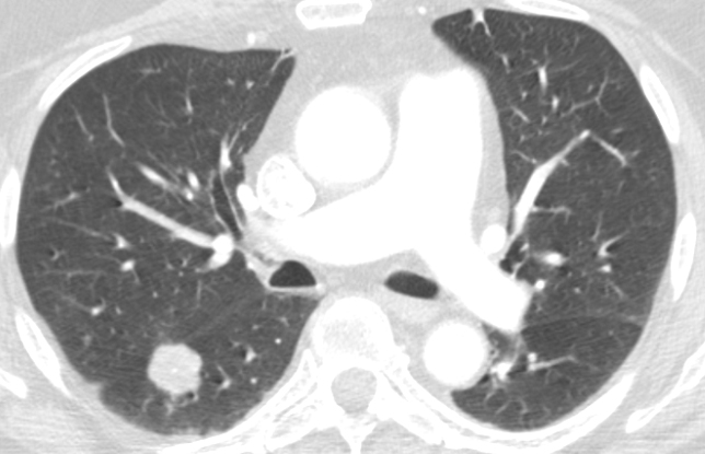 lobe pulmonary nodule
