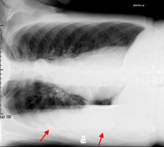 pleural effusion x ray lateral