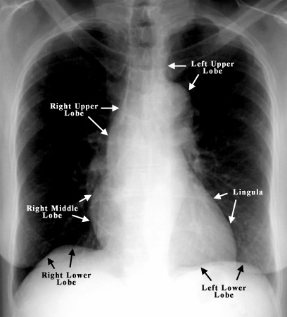 lingula lung