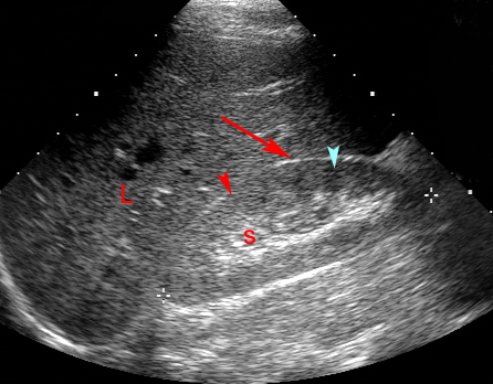 what do kidney stones look like on ultrasound