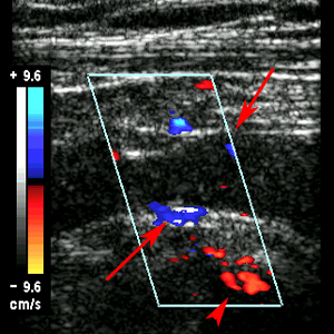 blood clot in arm ultrasound
