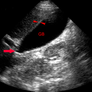 gallbladder ultrasound cancer
