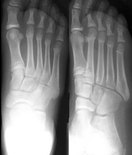 midfoot fracture