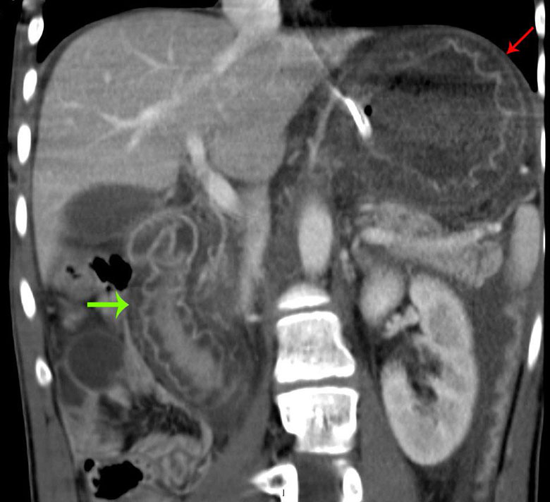 Acute Gastritis