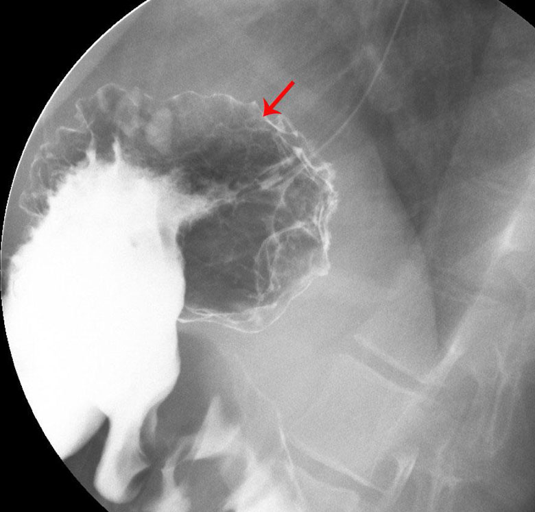 Acutre Gastritis