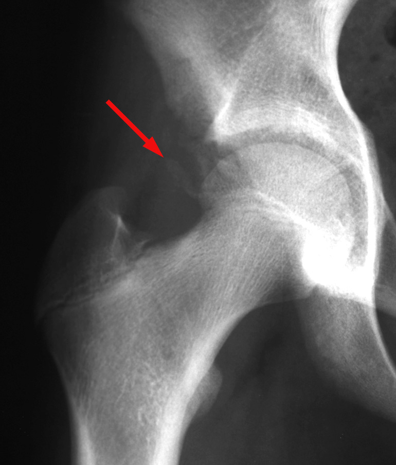 Injury of the Iliac Crest Apophysis, Radiology Case