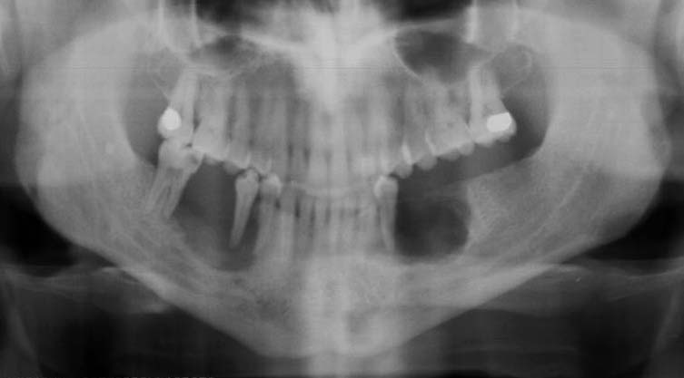 langerhans cell histiocytosis jaw