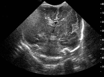 intraventricular hemorrhage ultrasound