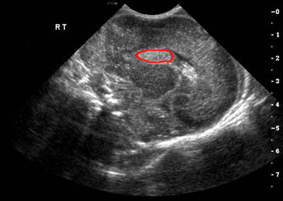intraventricular hemorrhage ultrasound
